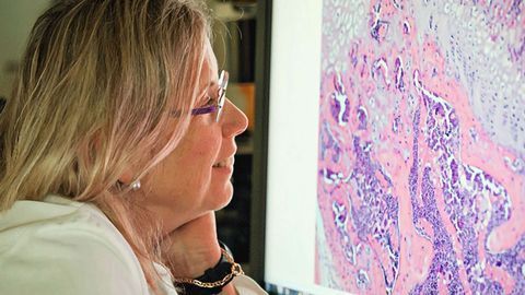 AI Utilized to Predict Cancer's Migration to the Brain