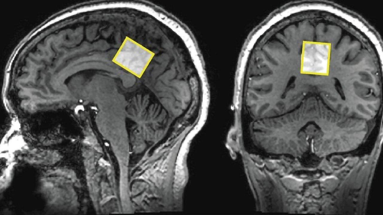 Mild Cognitive Impairment and Signaling Explored With MRS Scan