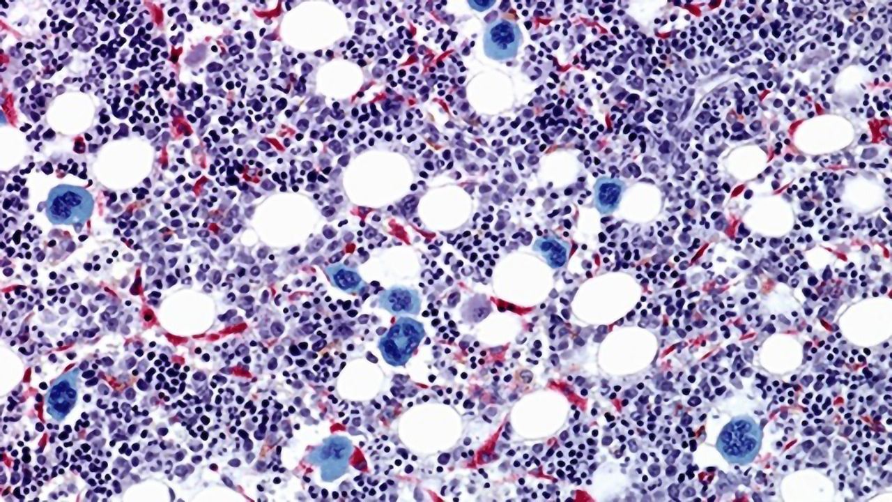 Chemokine Maintains Dormancy of "Sleeper Stem Cells" in Leukemia Subtype