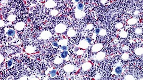 Chemokine Maintains Dormancy of "Sleeper Stem Cells" in Leukemia Subtype