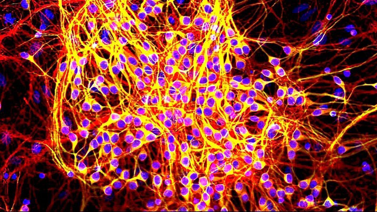 Precise Informatics Platform Targets Tau Tangles