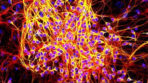 Precise Informatics Platform Targets Tau Tangles