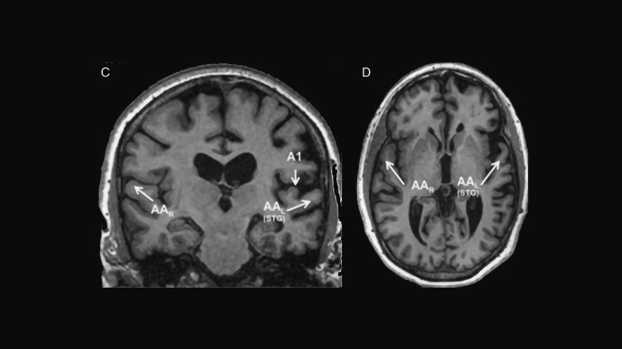 Brain Region Explains Why Aphasia Patients Can Understand Written, But Not Spoken Words