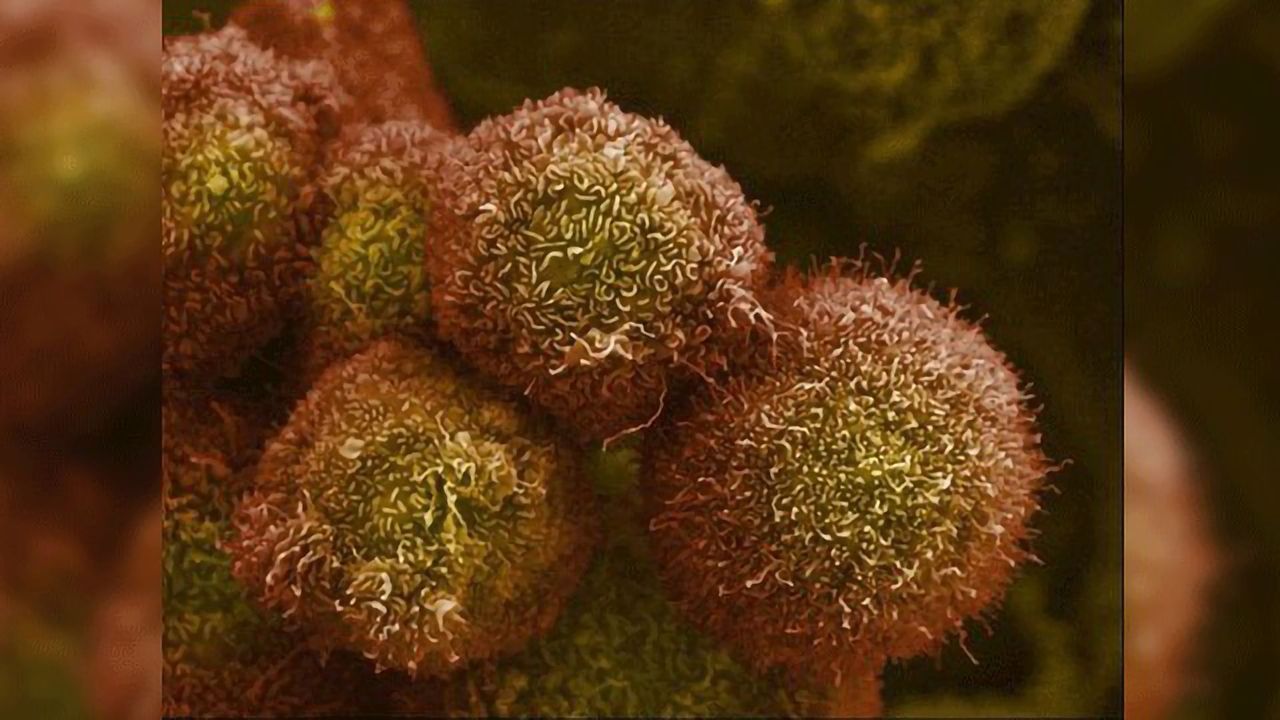 How Immune Cells Thwart Chemo in Pancreatic Cancer