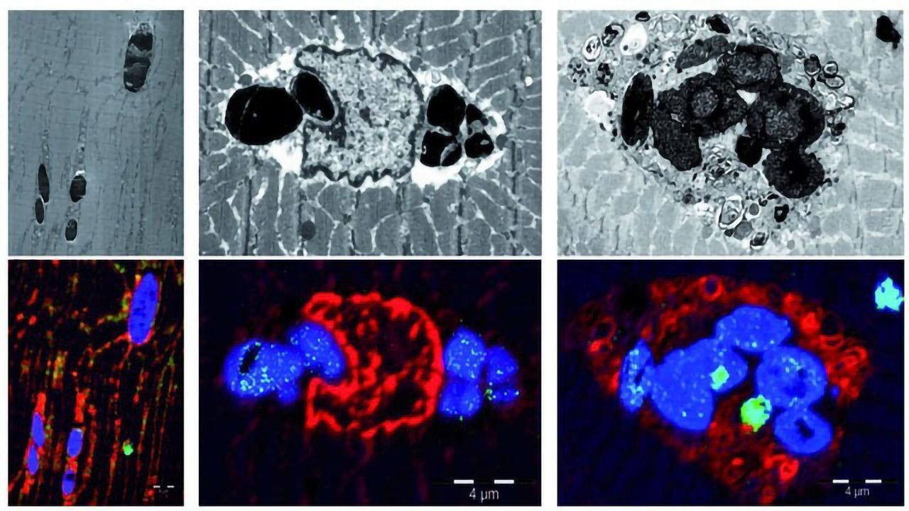 First Disease Caused by a Mutation in Myoglobin Identified
