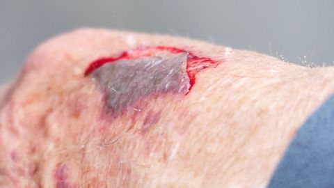 Wound Infection Bacterium Weaponizes Itself With Resident Virus
