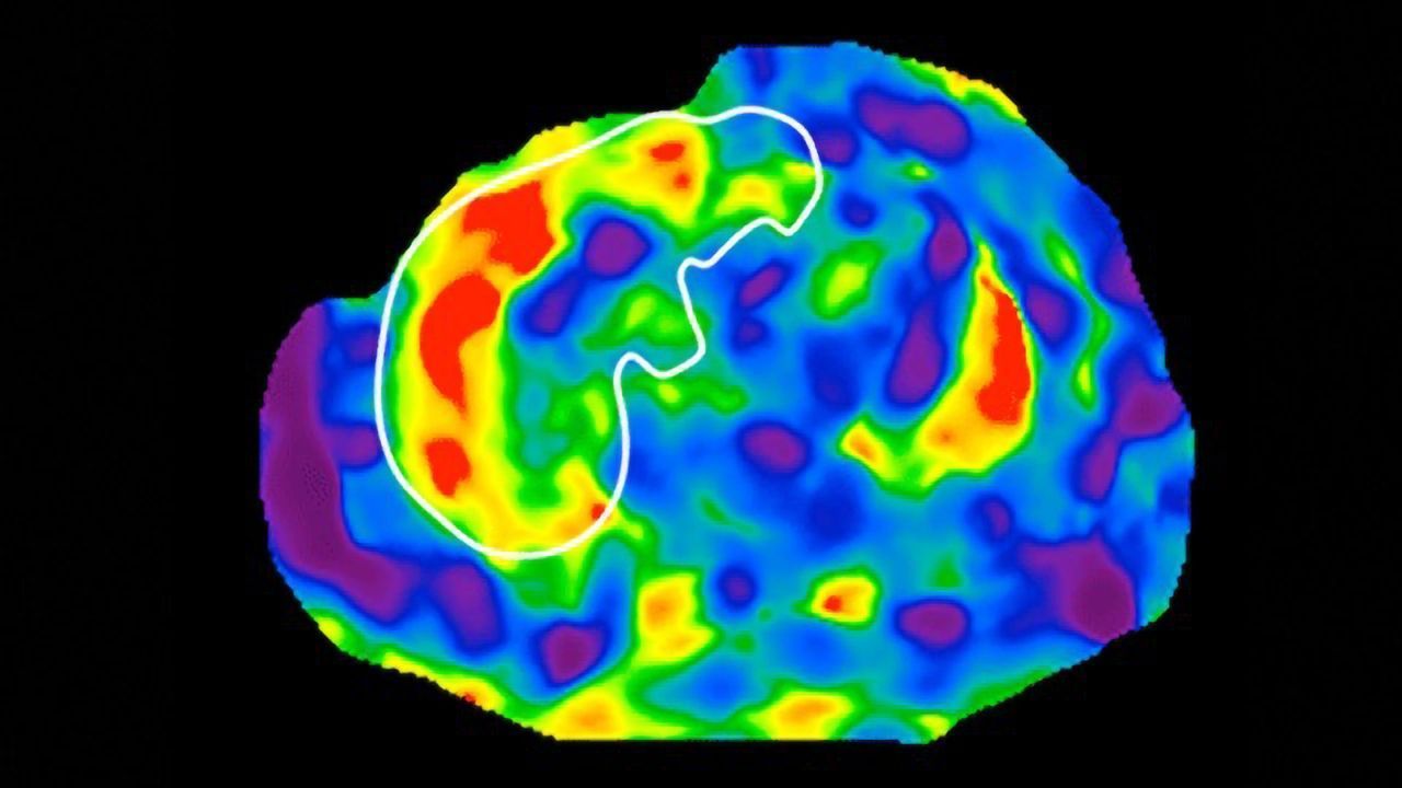 Movement Toward a Poop Test for Liver Cirrhosis