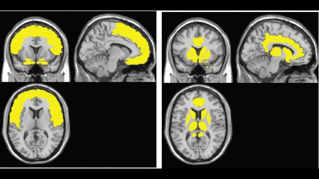 Novel Brain Map Tracks Early Brain Atrophy From HIV Infection