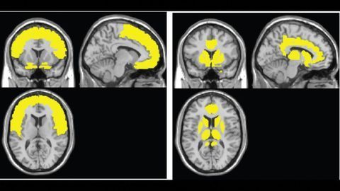 Novel Brain Map Tracks Early Brain Atrophy From HIV Infection