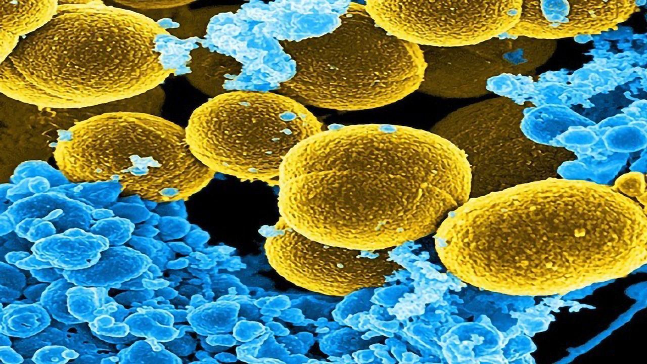 Maybe "Leaky Gut" Should Be Considered in HIV Treatment