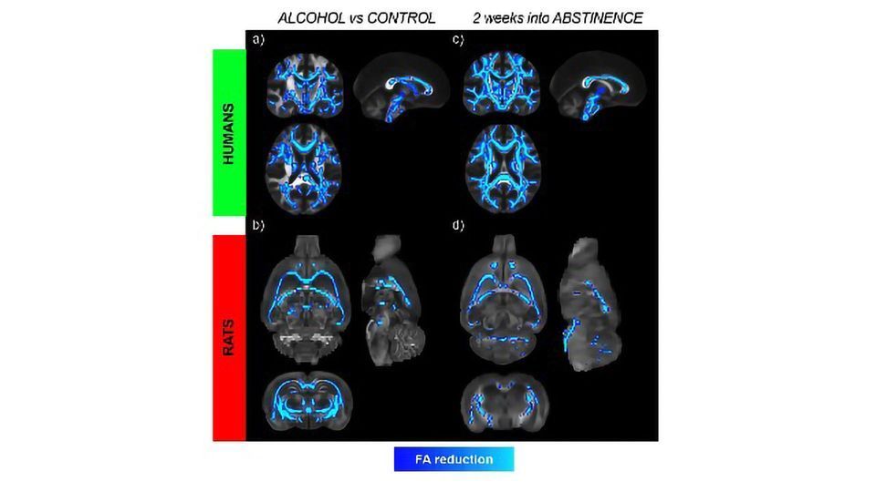 Alcohol-induced Brain Damage Might Continue for Weeks During Abstinence content piece image