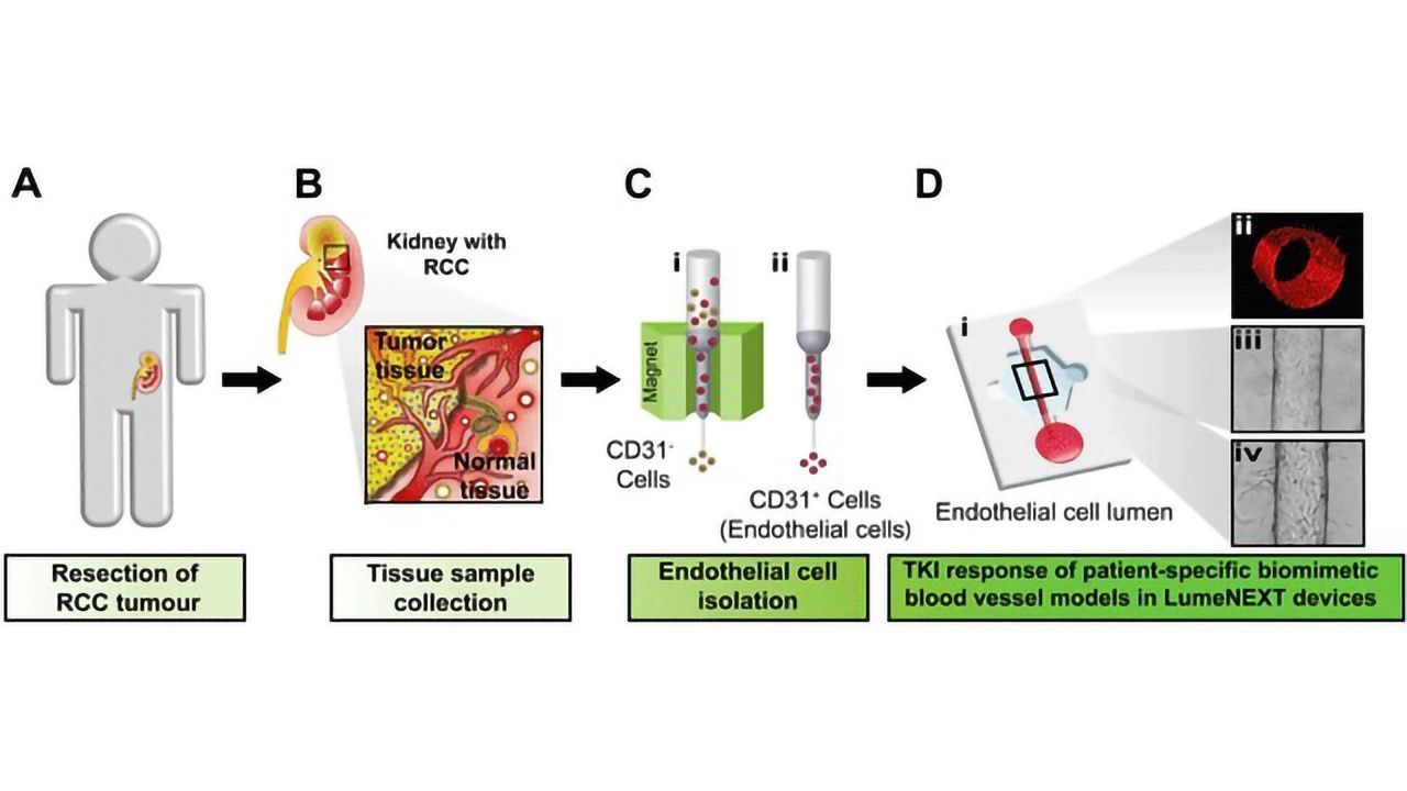 A Personalized Microfluidic Model for Kidney Cancer Drug Screening