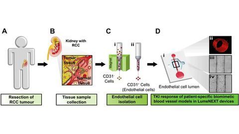 A Personalized Microfluidic Model for Kidney Cancer Drug Screening