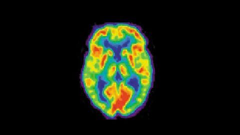 PET Biomarker Predicts Alzheimer's Progression