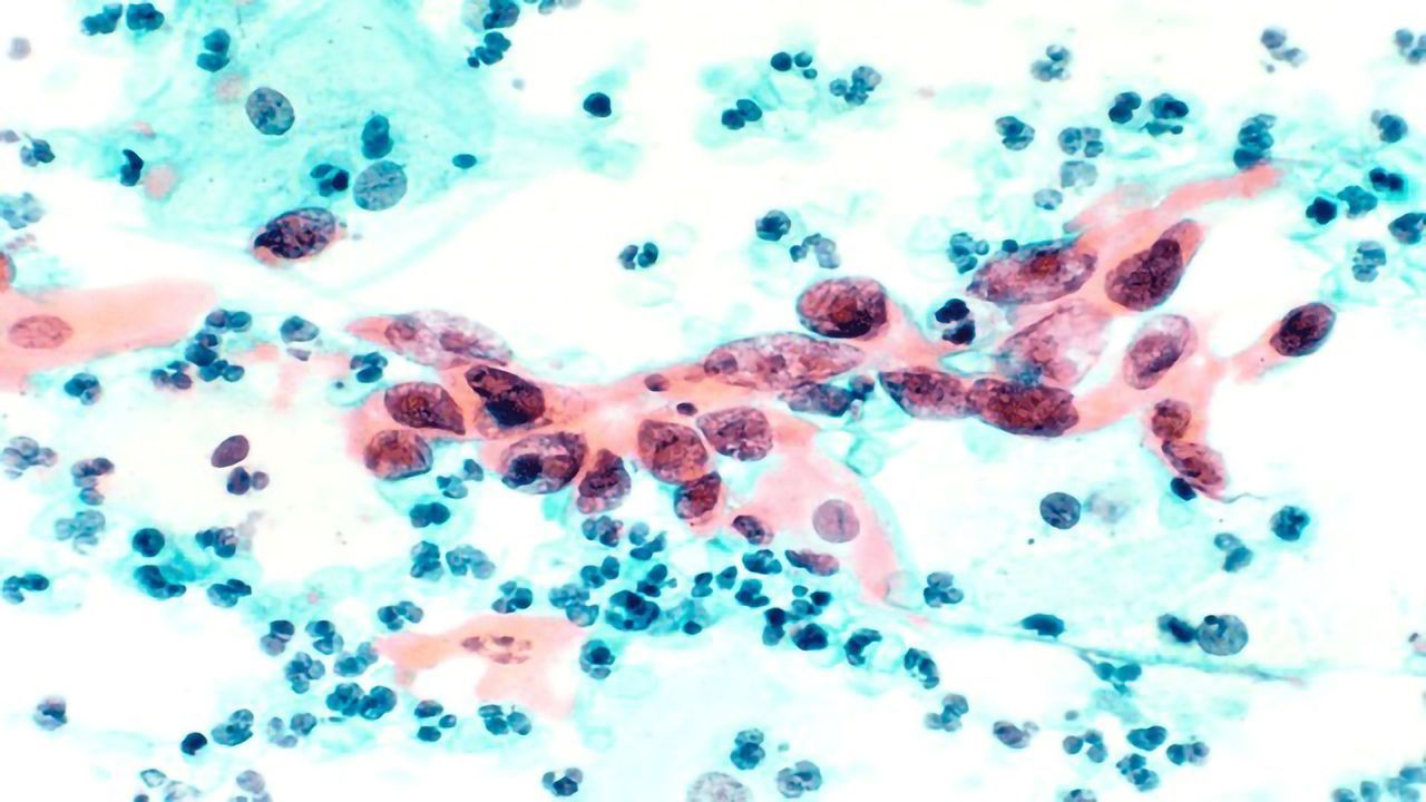 Therapeutic Vaccine Targets Underlying HPV Infection and Precancer Lesions