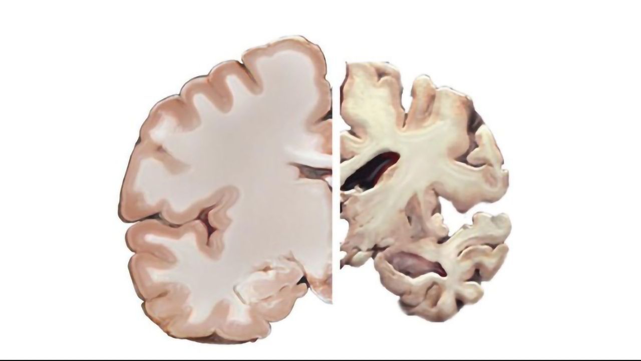 Anti-inflammatory Drugs Prove Ineffective for Alzheimer's Prevention