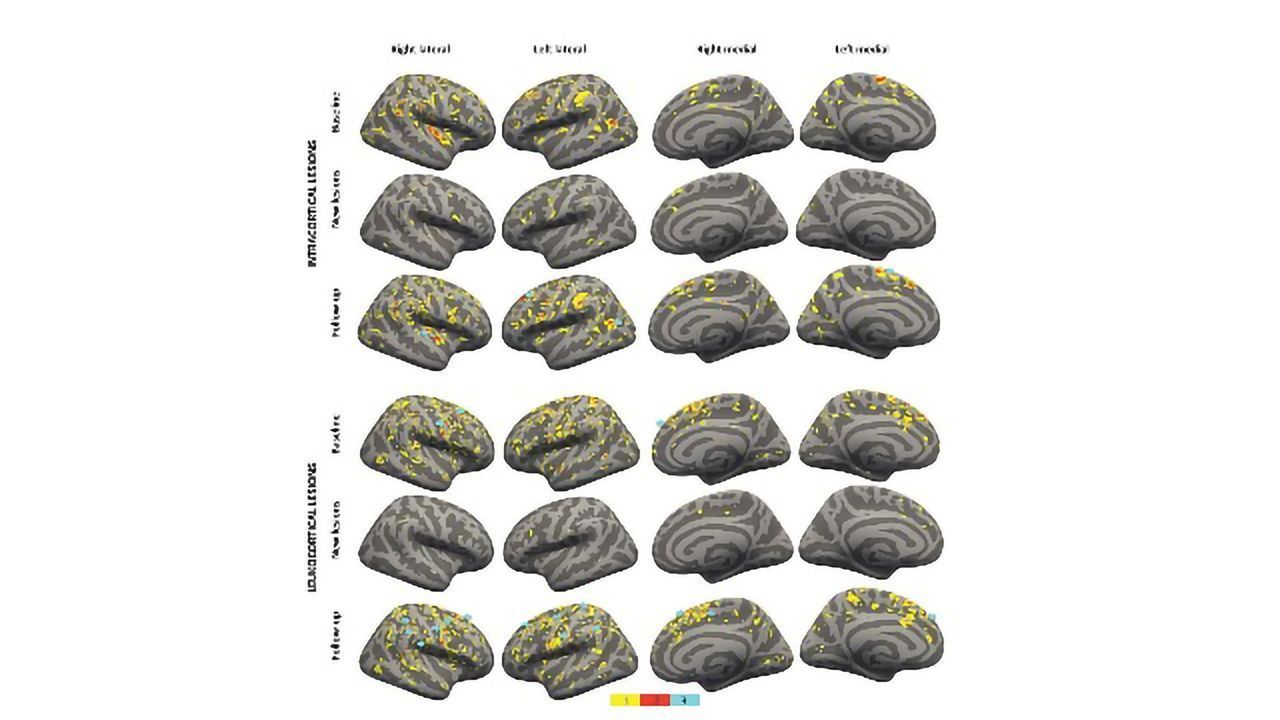 High-strength MRI Tracks MS Progression