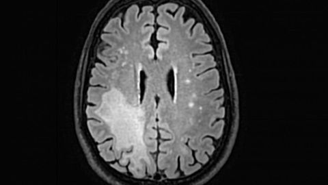 Fatal Brain Infection Helped by Releasing the Immune Handbrake