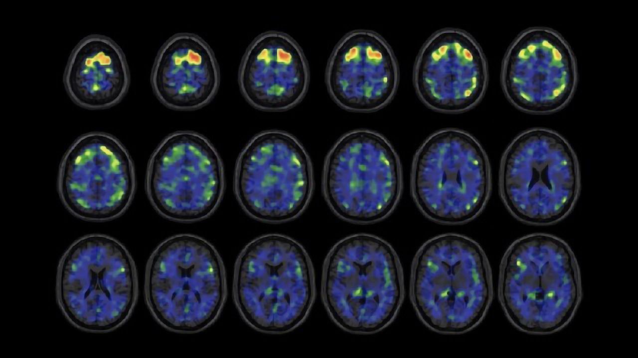 Experimental PET Scan Detects Tau Protein in NFL Players