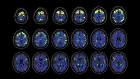 Experimental PET Scan Detects Tau Protein in NFL Players