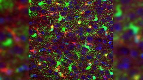 Finding Drivers of Pediatric Brain Cancer Presents Therapeutic Possibilities