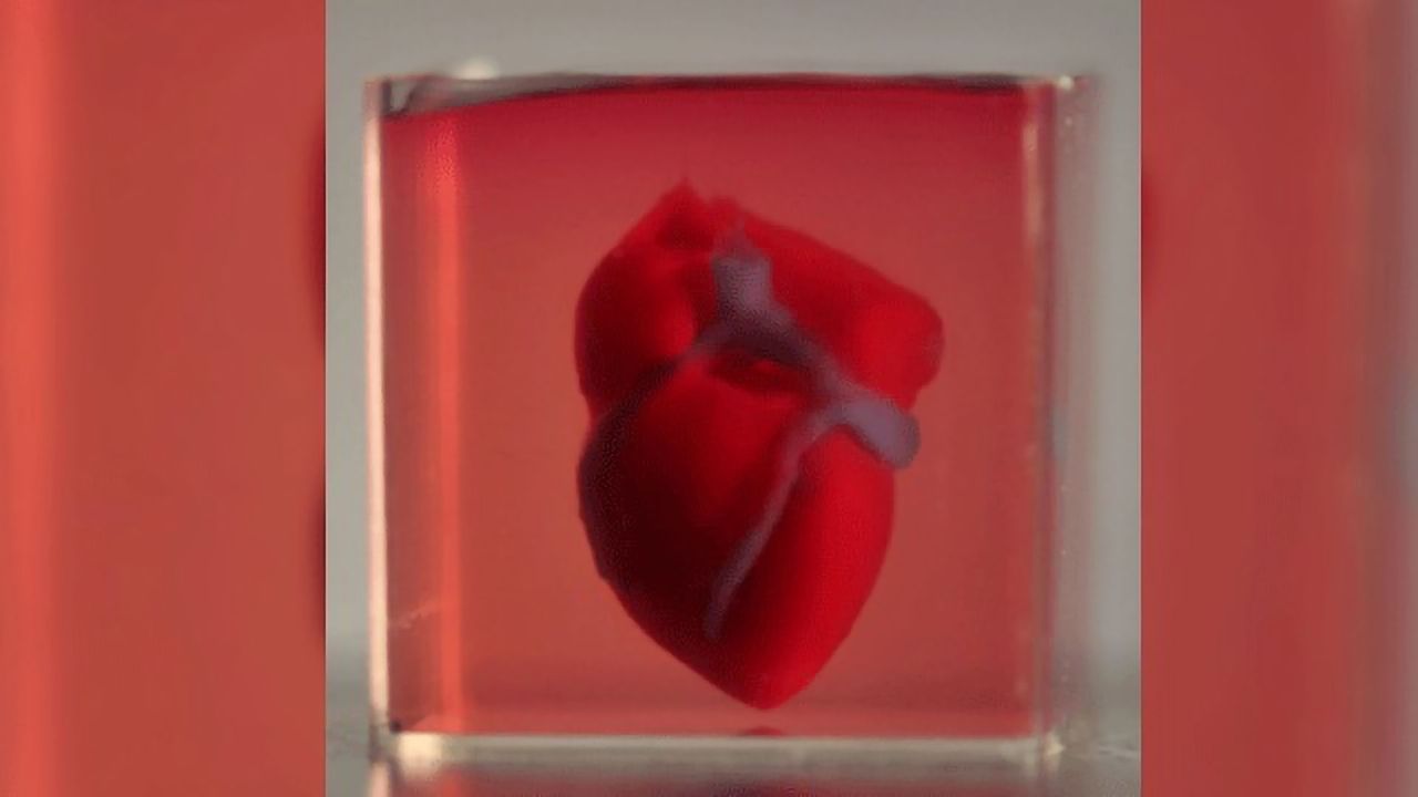 3D Heart Printed Using Patient's Own Tissue