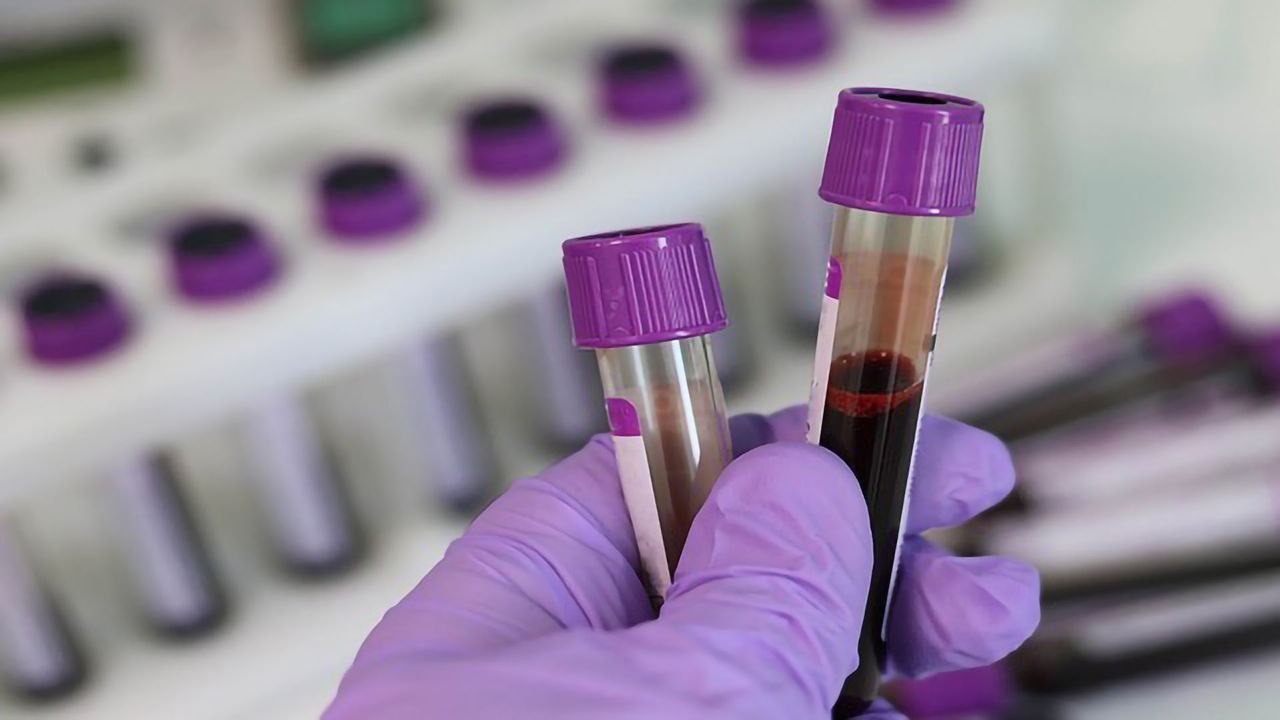 Blood Test for Detecting Pre-symptomatic Alzheimer's Disease is Refined