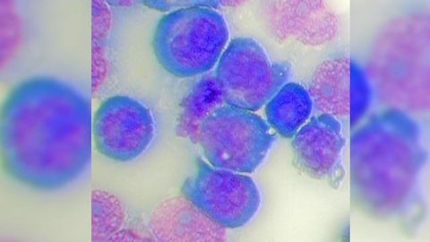 Hyperactive Form of IRAK4 Protein Fuels Cancerous Cells