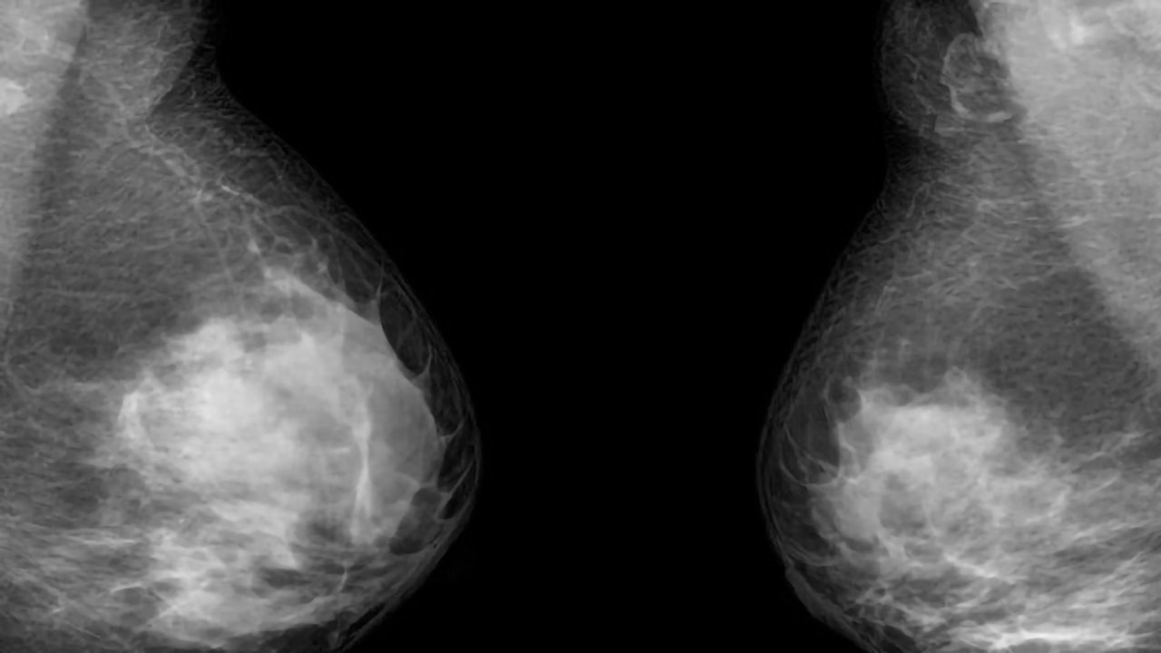 Blood Test Detects 16 Out of 18 Breast Cancer Relapse Cases