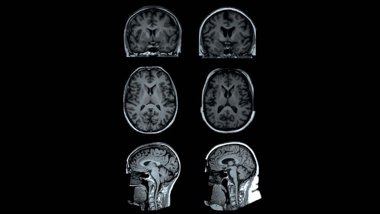 Obesity Linked to Changes in Brain Structure