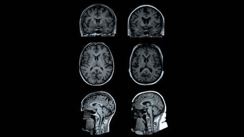 Obesity Linked to Changes in Brain Structure