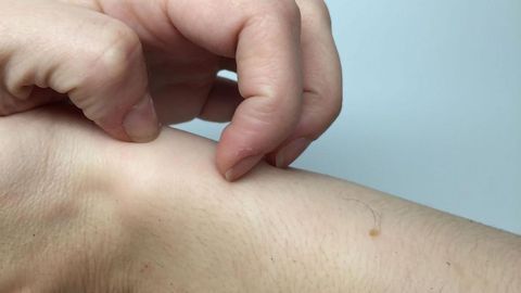 Gut Primed for Allergic Reaction by Scratching
