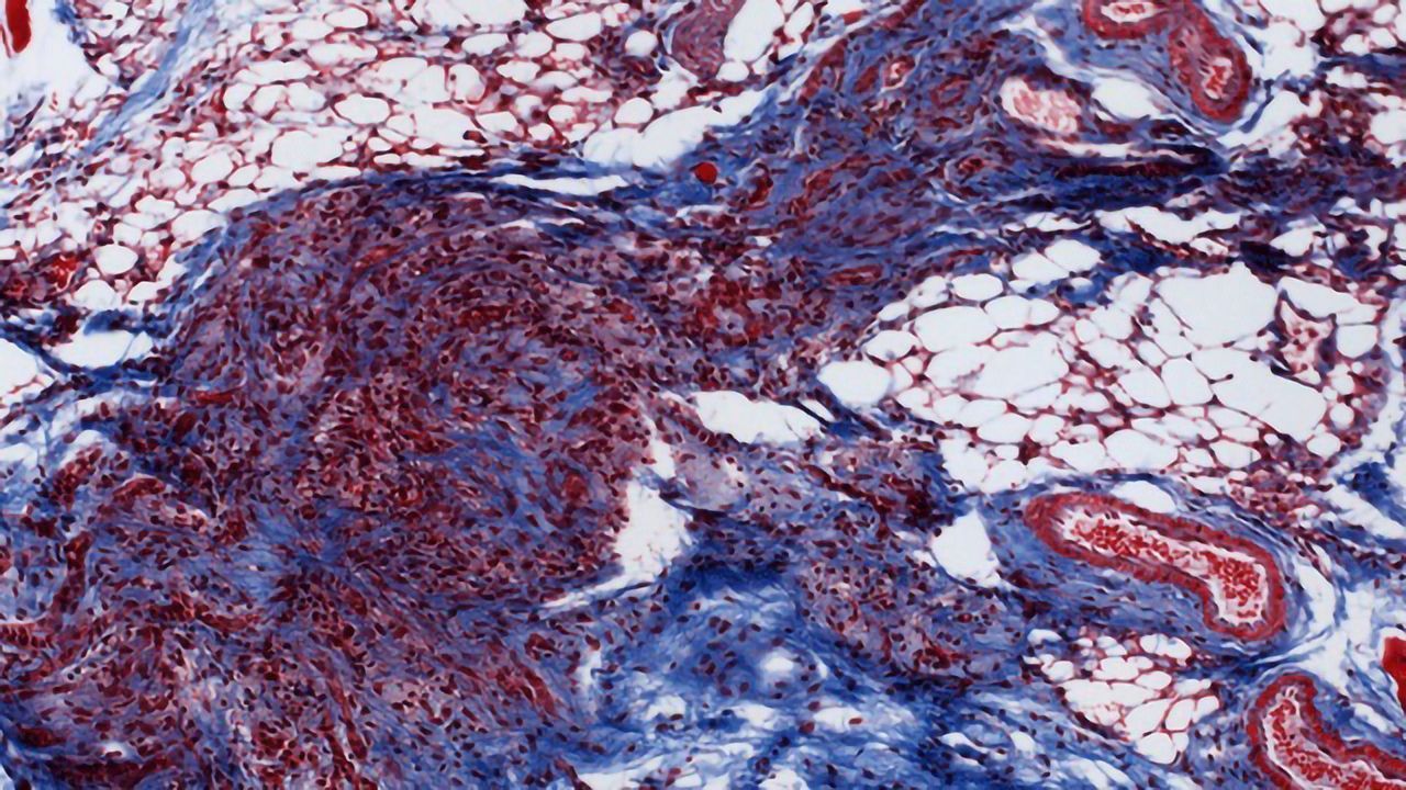 Mapping Route to Recurrence in Breast Cancer Cells