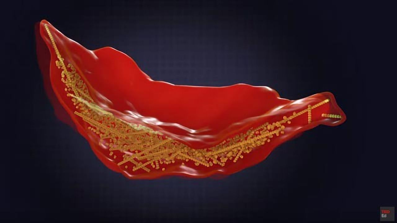 Sickle Cell Disease – What Causes It and How Can It Be Treated?