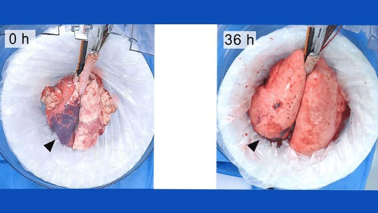 Regeneration of Severely Damaged Lungs a Transplant Game-changer