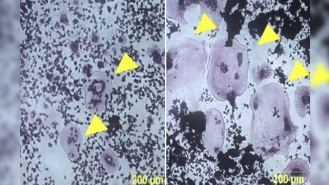 How Toxin Exposure Can Weaken Your Bones