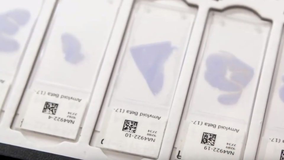 AI Tool Recognizes Amyloid Plaques in Brain Tissue Samples Technology