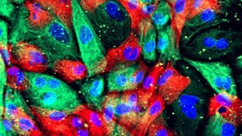 Prostate Cancer Cells Mimic Bone-forming Cells When They Metastasize