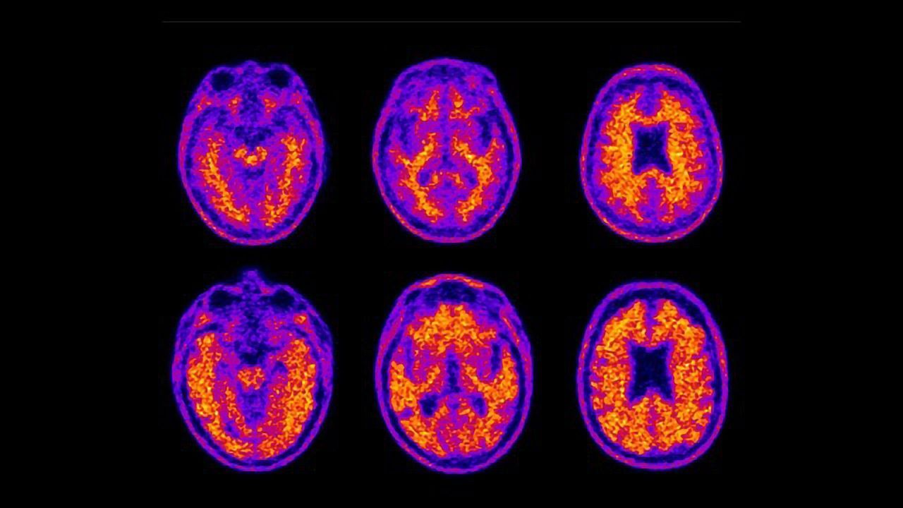 Poor Money Management Correlates With Amyloid Plaque Buildup in Old Age