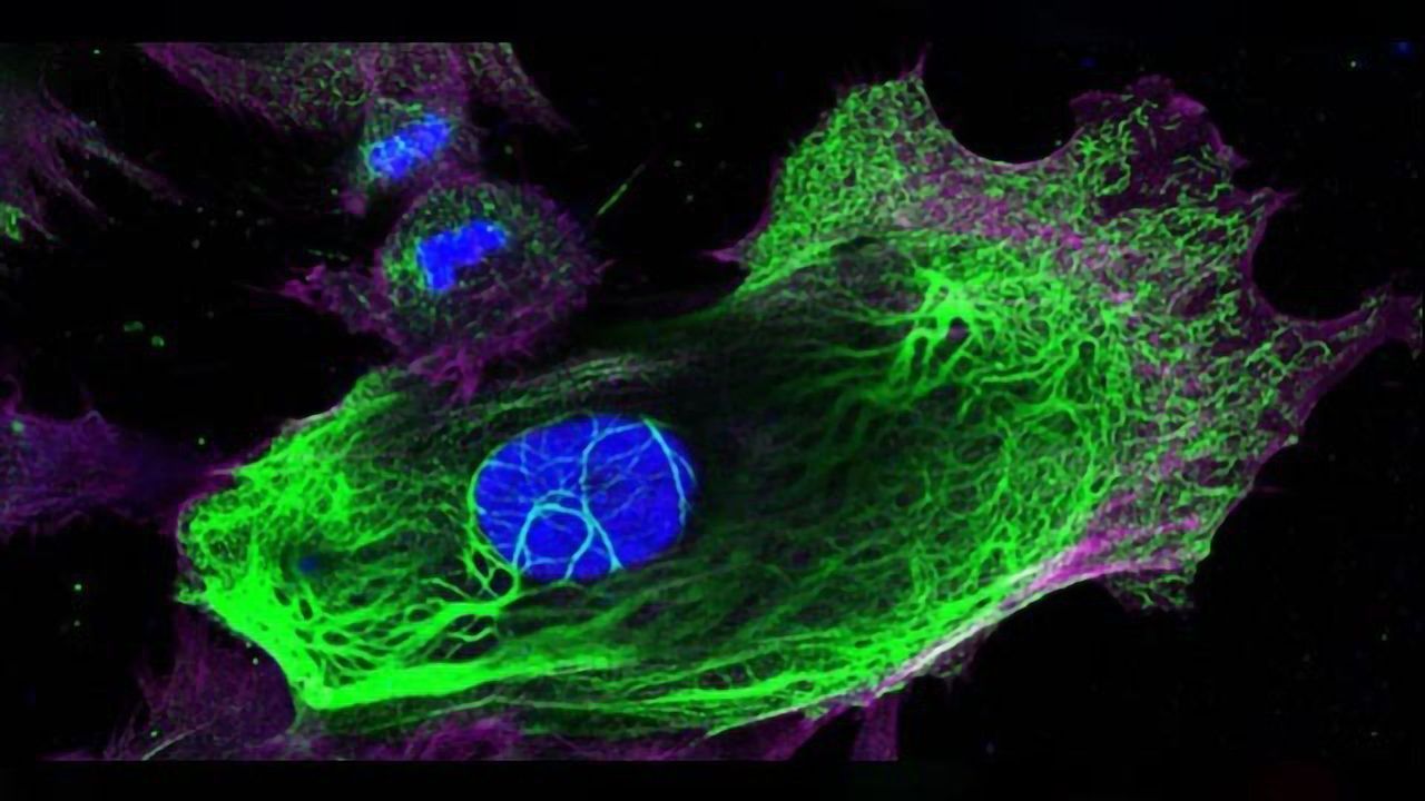 Genetic “Switch” Helps Breast Cancer Spread