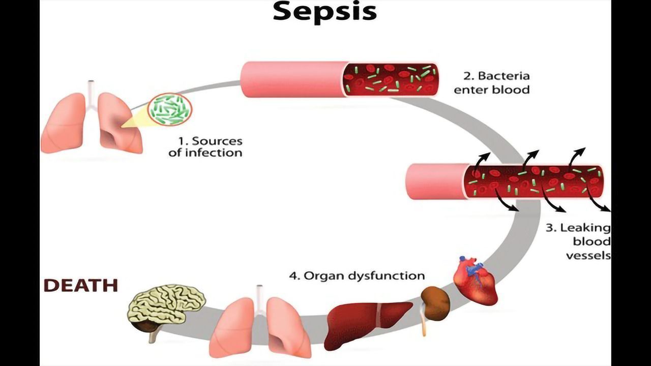 Metabolism-Immunology Interaction Likely to Be Important for Understanding Sepsis