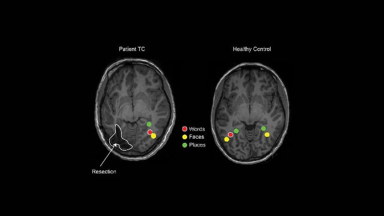 Children's Brains Dramatically Rewire to Retain Perception After Epilepsy Surgery