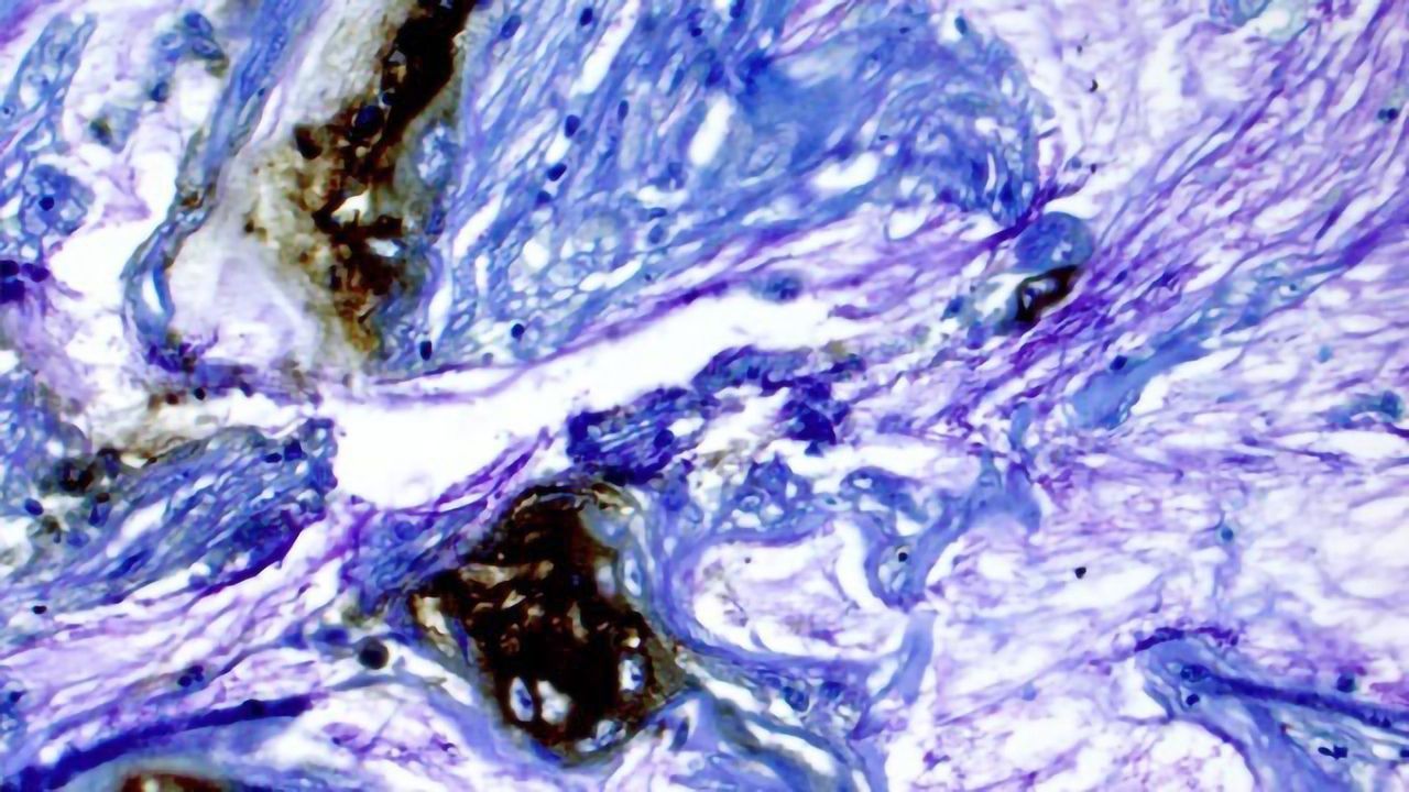 Team Identify Pancreatic Cysts Likely to Become Cancerous With 95% Accuracy Using Biomarker