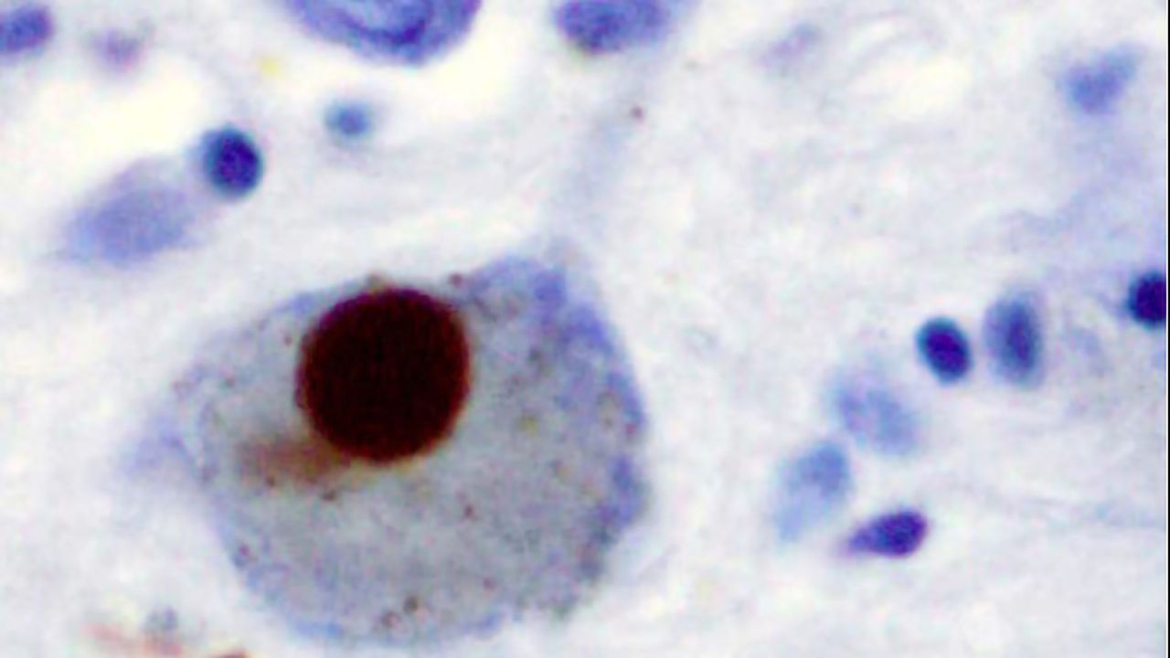 Alpha-synuclein Mouse Study Stops Parkinson's Before it Can Begin