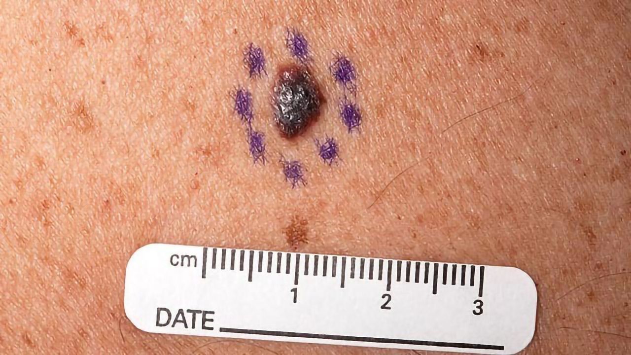 Three-drug Combo Helps Curb Deadly Skin Cancer Growth