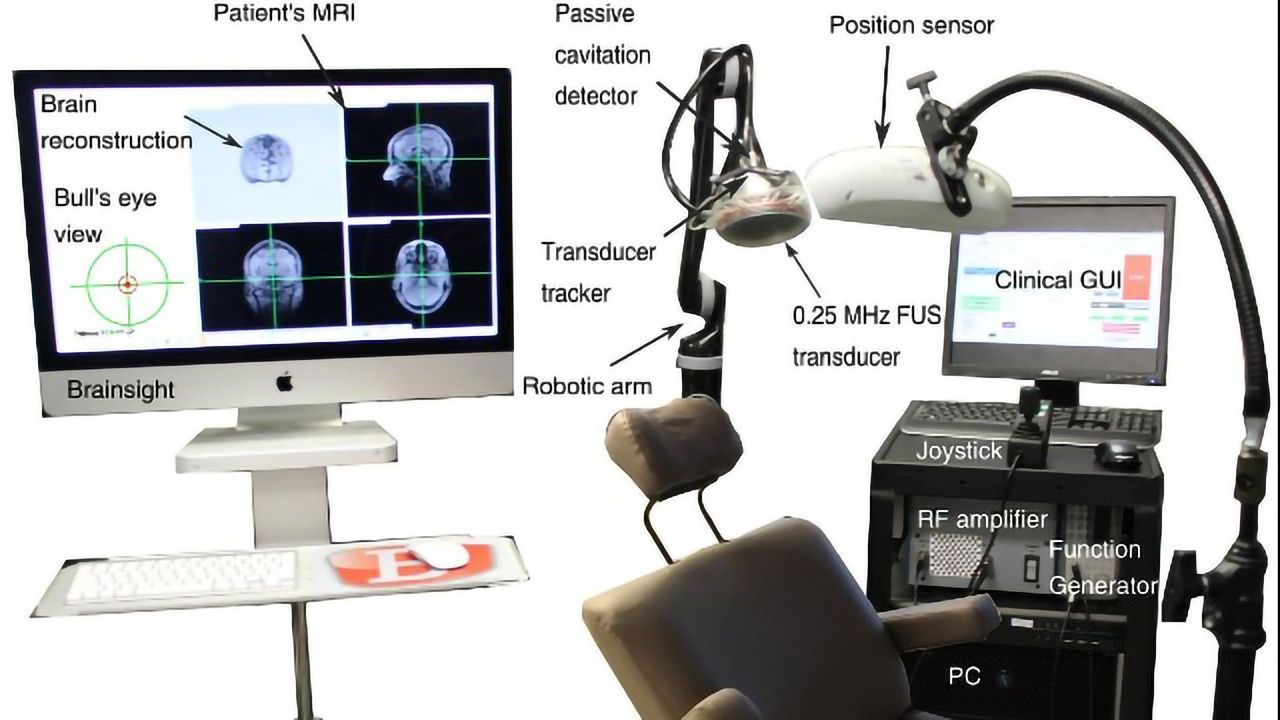 New Ultrasound Method Restores Dopaminergic Pathway in Early Stages of Parkinson's Disease
