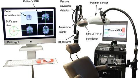New Ultrasound Method Restores Dopaminergic Pathway in Early Stages of Parkinson's Disease