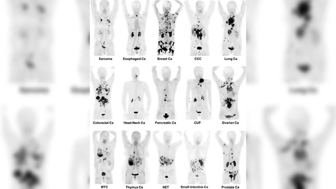 Radiotracer Identifies 28 Different Kinds of Cancer