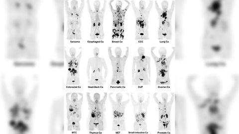 Radiotracer Identifies 28 Different Kinds of Cancer