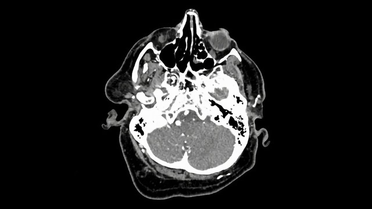 Brain Aneurysm Detection Aided by AI